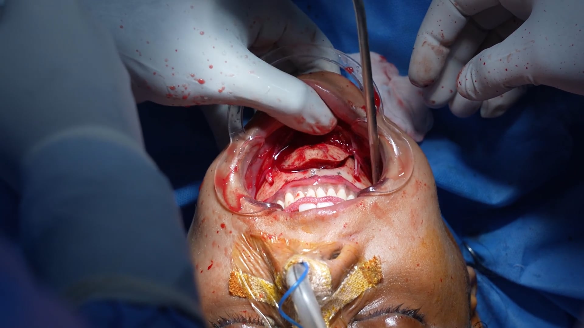 Genioplasty Surgery
